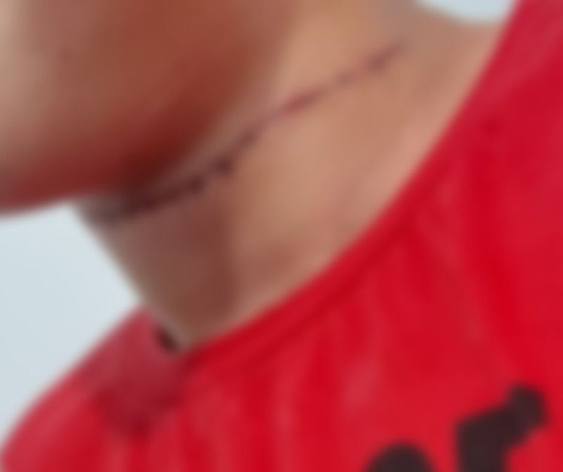 Menino de 13 anos tem o pesco&ccedil;o cortado por linha de cerol em Cambori&uacute; – Foto: Arquivo pessoal/Reprodu&ccedil;&atilde;o/ND