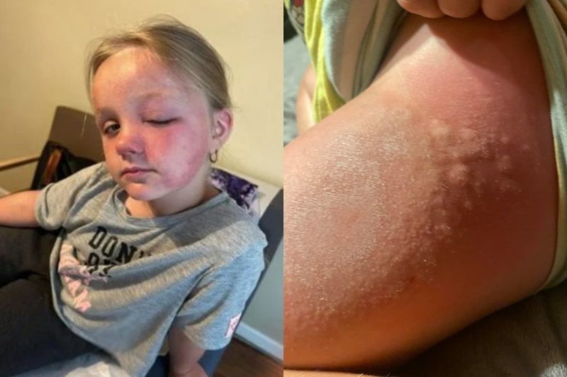 Menina de 6 anos teve s&eacute;rios problemas de sa&uacute;de ap&oacute;s contato com a planta – Foto: Chavana Neuweg/Arquivo pessoal