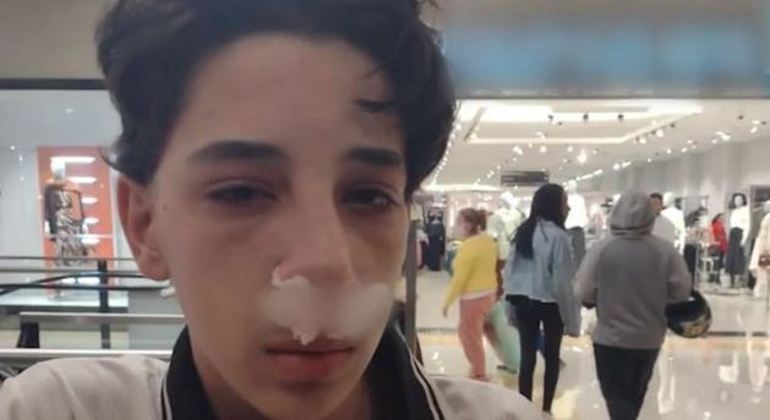 O adolescente de 14 anos teve o nariz quebrado em dois lugares pelo segurança do shopping &#8211; Foto: Internet/Reprodução/ND