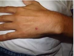 10&deg; caso da doen&ccedil;a foi confirmado em Florian&oacute;polis – Foto: DIVE-SC/Divulga&ccedil;&atilde;o/ND