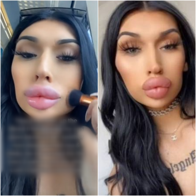 preenchimento labial