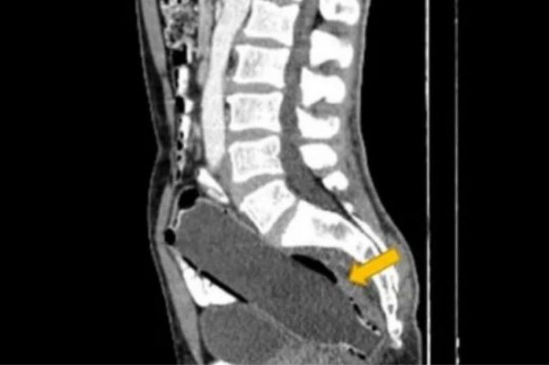 Homem estava com uma garrafa alojada no intestino – Foto: Reprodu&ccedil;&atilde;o