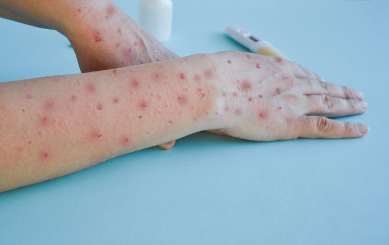 Brazil has 2,747 confirmed cases of monkeypox.  Photo: Disclosure/ND