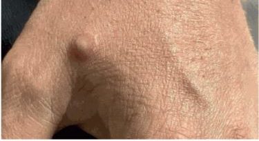 Santa Catarina segue sem previs&atilde;o de vacina&ccedil;&atilde;o contra var&iacute;ola dos macacos – Foto: Eurosurveillance/Divulga&ccedil;&atilde;o/ND