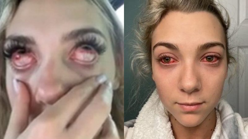 ‘Achei que ficaria cega’: extens&atilde;o de c&iacute;lios deixa jovem aterrorizada ap&oacute;s rea&ccedil;&atilde;o – Foto: Reprodu&ccedil;&atilde;o/NY Post