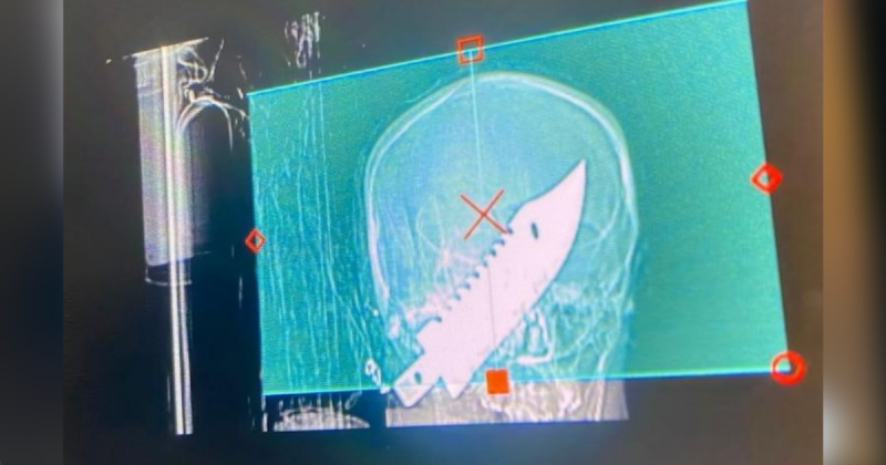 Exame mostra faca crava no cr&acirc;nio da vitima – Foto: Pol&iacute;cia Civil/Divulga&ccedil;&atilde;o/ND