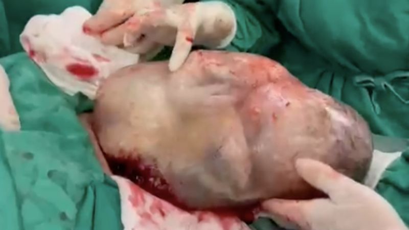 Beb&ecirc; nasceu empelicado dentro da bolsa – Foto: Bruna Costa Fotografias/Reprodu&ccedil;&atilde;o/ND