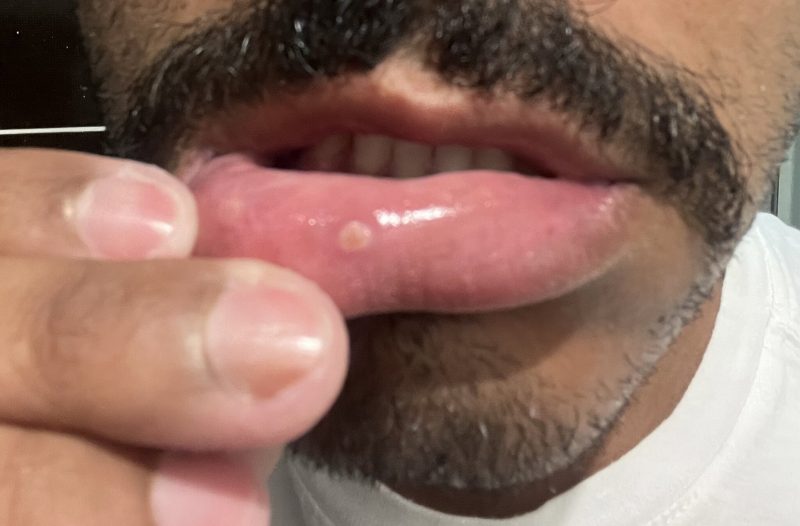 varíola dos macacos