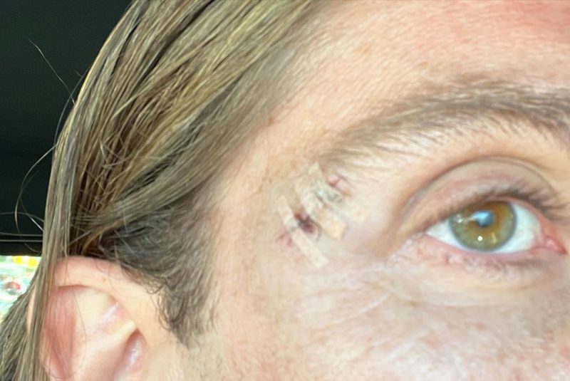 Filipe Luís acabou cortando o supercílio após esbarrão em obstáculo 