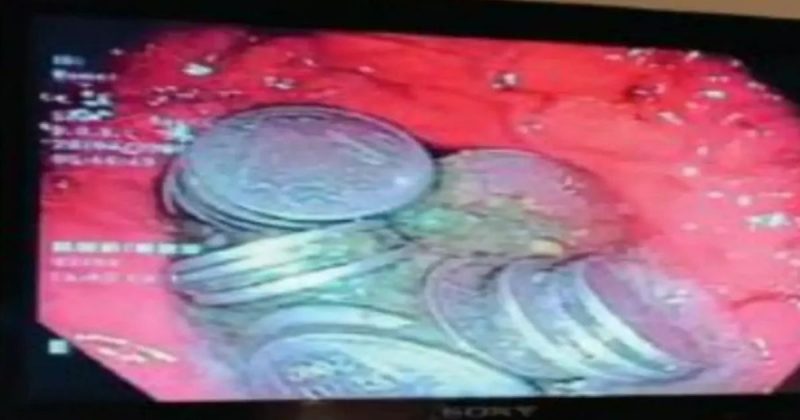 Nada menos que 63 moedas estavam no est&ocirc;mago do homem – Foto: Reprodu&ccedil;&atilde;o