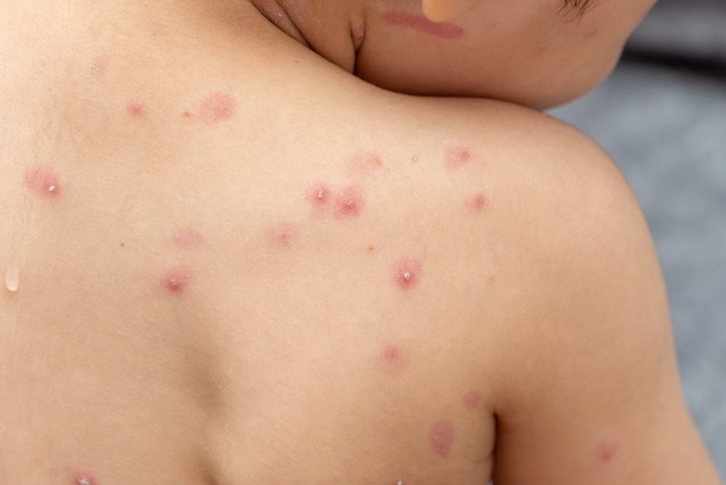 Monkeypox has killed four people in Brazil, Cuba and Ecuador – Photo: Shutterstock/ND