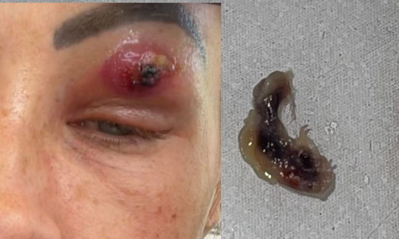 a woman had a creature removed from her eyes