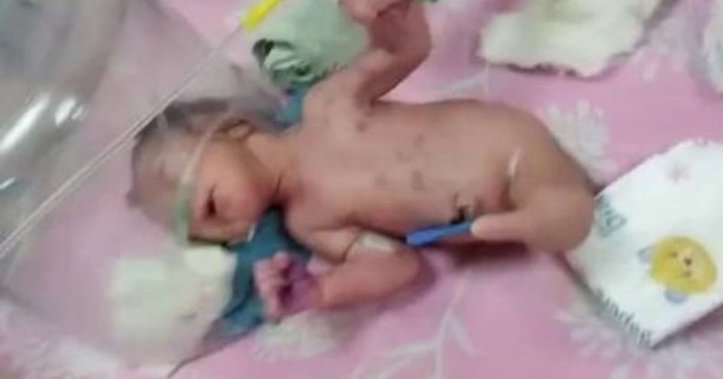 Baby born with mermaid tail, not a boy or a girl, intrigues doctors 3 Child has no genital organ, therefore, it is neither a boy nor a girl – Photo: reproduction