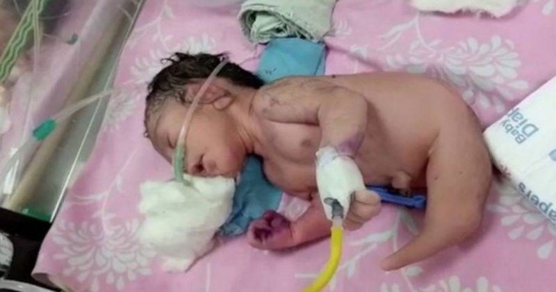 Baby born with rare formation called Mermaid Syndrome –  photo: mermaid