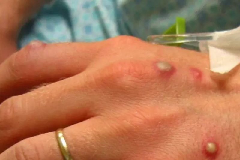 Cidade soma cinco casos da doen&ccedil;a – Foto: Reprodu&ccedil;&atilde;o/ND