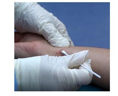 Exemplo de exame para diagn&oacute;stico de var&iacute;ola dos macacos – Foto: SES-DF/Reprodu&ccedil;&atilde;o/ND