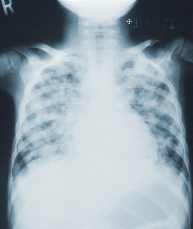 Quando a doen&ccedil;a evolui para a pneumonia, &eacute; comum haver falta de ar, dor no peito e que a pessoa cuspa bolas de sangue. – Foto: Unsplash/Divulga&ccedil;&atilde;o/ND