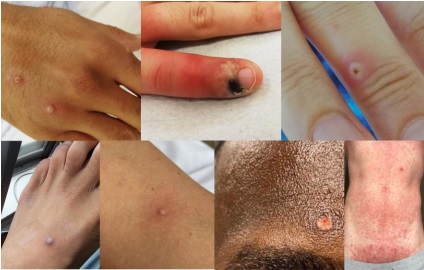 Santa Catarina tem 323 confirmados com a doen&ccedil;a – Foto: Prefeitura de Balne&aacute;rio Cambori&uacute;/Reprodu&ccedil;&atilde;o/ND