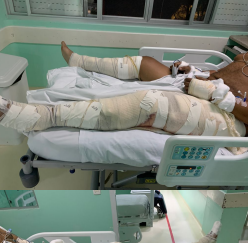 Alexsandro enfrenta dificuldades para a colagem dos ossos – Foto: Arquivo Pessoal/ND