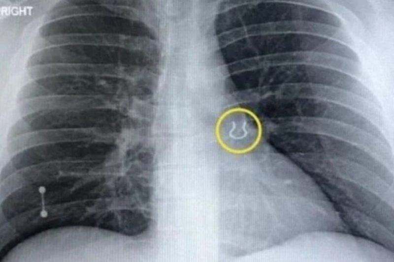 Piercing do nariz perdido foi parar no pulm&atilde;o do americano – Foto: REPRODU&Ccedil;&Atilde;O/JOEY LYKINS/NY POST