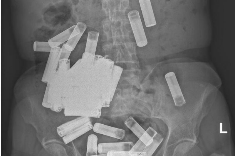 Pilhas estava armazenadas no est&ocirc;mago da mulher – Foto: Reprodu&ccedil;&atilde;o