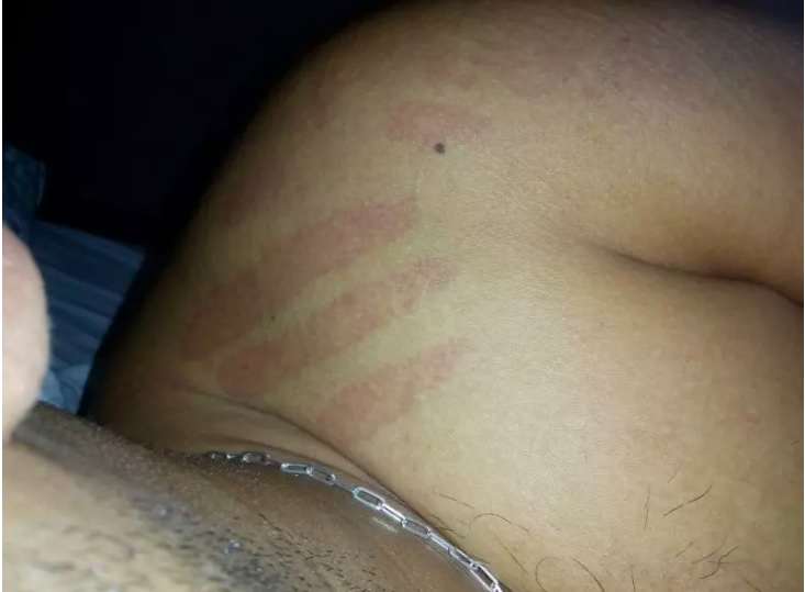 Marcas misteriosas apareceram no ombro do rapaz &#8211; Foto: Divulgação ND