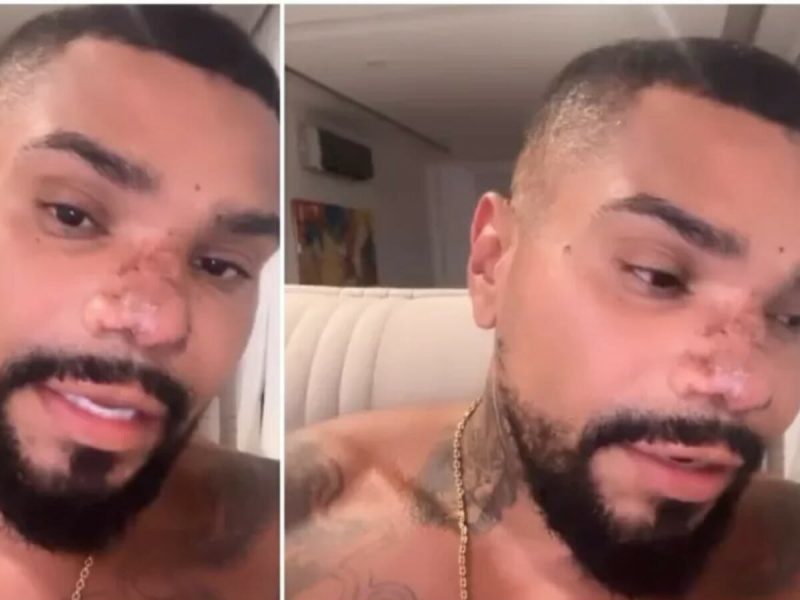 Naldo aparece em vídeo com as marcas do princípio de necrose no nariz – Foto: Divulgacão/Observatório dos Famosos/ND