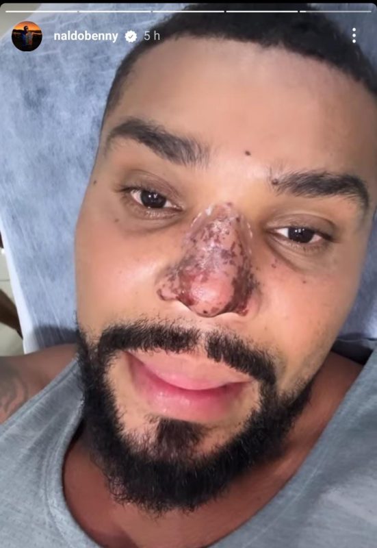 Cantor surpreendeu f&atilde;s ao aparecer com manchas escuras no nariz – Foto: NaldoBenny/Divulga&ccedil;&atilde;o/ND