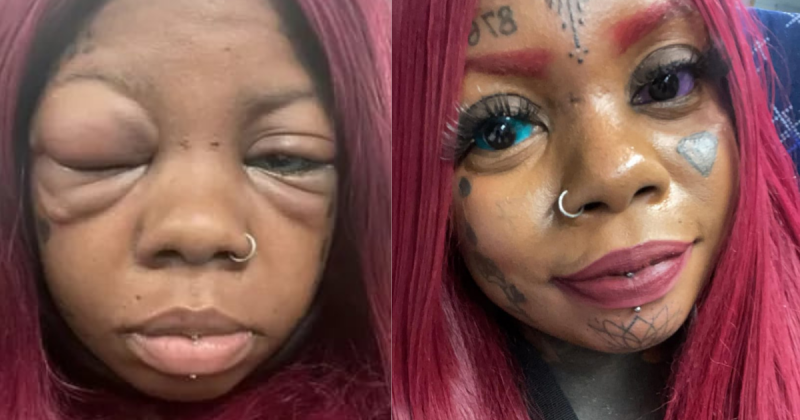 No perfil da TikToker &eacute; poss&iacute;vel ver as imagens dos momentos mais cr&iacute;ticos da inflama&ccedil;&atilde;o – Foto: Instagram/Reprodu&ccedil;&atilde;o/ND