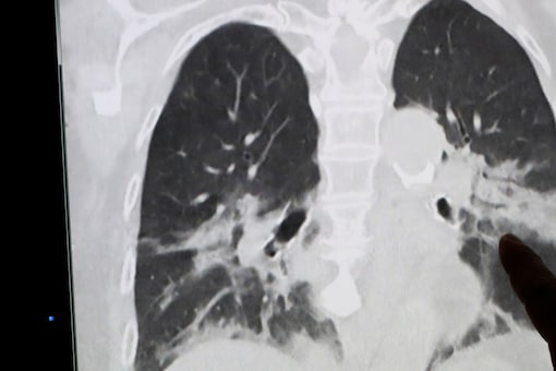 Essa condi&ccedil;&atilde;o de &ldquo;feto dentro do feto&rdquo; surge quando um feto com desenvolvimento anormal &eacute; encontrado dentro do corpo de seu g&ecirc;meo, que &eacute; saud&aacute;vel – Foto: Reprodu&ccedil;&atilde;o