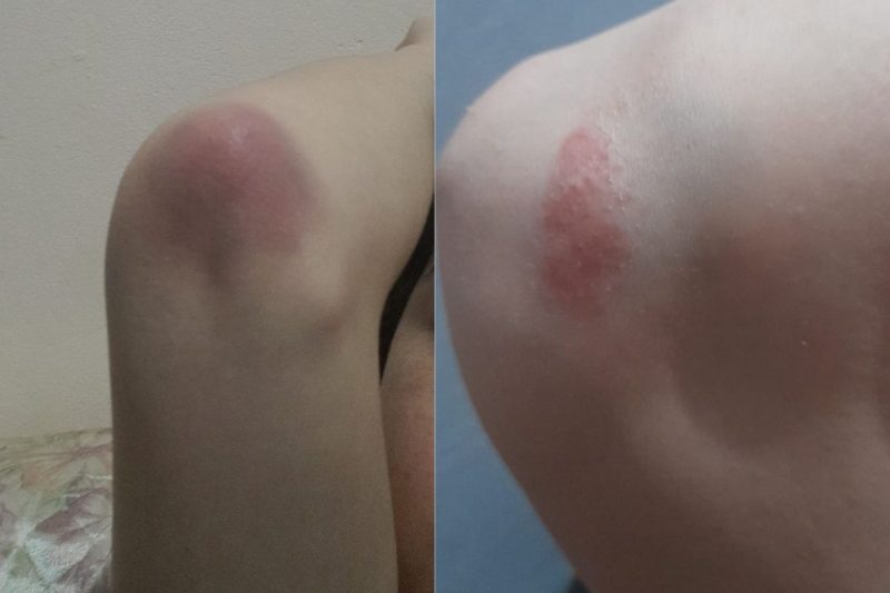 Laura teve ferimentos no joelho e cotovelo – Foto: Arquivo Pessoal/ND