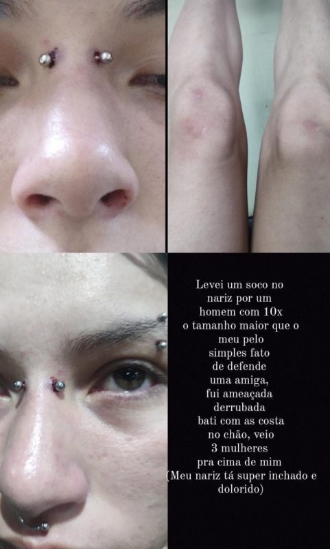 Jovem recebeu um soco no rosto ap&oacute;s tamb&eacute;m tentar socar um seguran&ccedil;a. Jovens alegam que homem era muito maior e mais forte do que elas – Foto: Arquivo Pessoal/ND