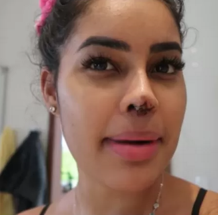 O caso não causou tanto quanto o do Naldo, mas foi semelhante. Sthe Matos, influenciadora, enfrentou sérios problemas no nariz em 2021. De acordo com a própria, após uma rinoplastia, tentou uma correção e acabou perdendo a cartilagem nasal, que caiu. Corrigiu fazendo “transplante” de cartilagem dos lábios e das orelhas. Tudo para não ficar sem nariz. – Foto: Reprodução