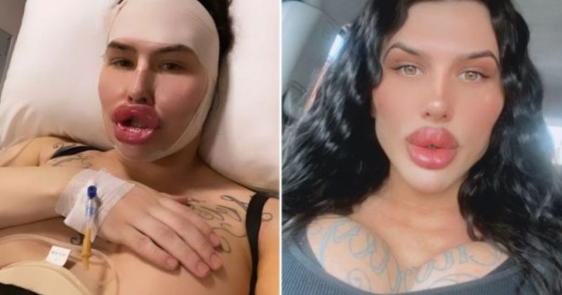 Modelo quer ter os maiores l&aacute;bios do mundo. Est&aacute; quase l&aacute; – Foto: Reprodu&ccedil;&atilde;o