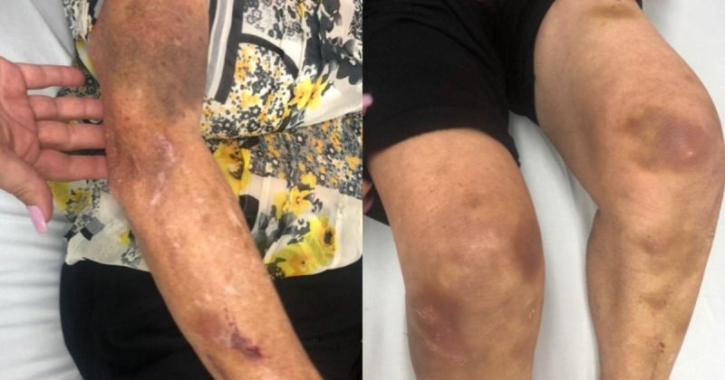 Idosa deu entrada na UPA Cordeiros com in&uacute;meros hematomas antigos e recentes – Foto: Reprodu&ccedil;&atilde;o/ND