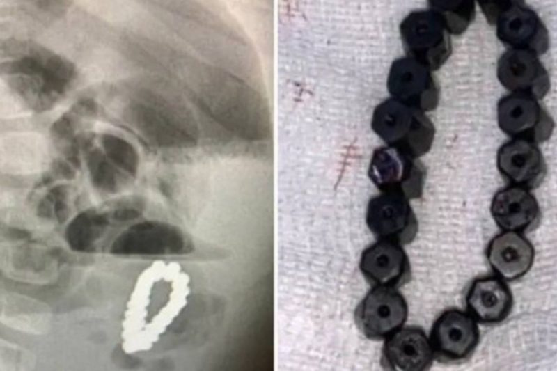 Menino de 4 anos engoliu bracelete com contas magn&eacute;ticas – Foto: Reprodu&ccedil;&atilde;o/Internet