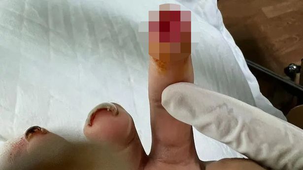 A tourist's finger was torn off - Photo: Reproduction / The Mirror / ND