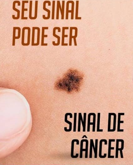 As pintas podem estar em qualquer parte do corpo e podem indicar um sinal de alerta para o c&acirc;ncer tipo melanoma – Foto: Divulga&ccedil;&atilde;o