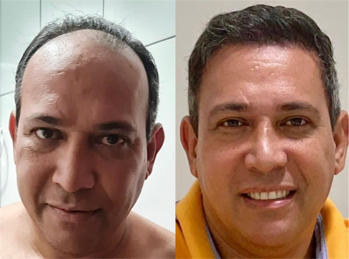 Before and after photos of people who regained their self-esteem after the procedures.  Photo: Divulgation/Capilar Brasil.