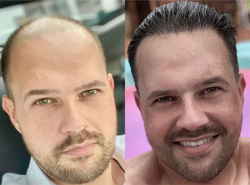 Imagens de antes e depois de pessoas que tiveram sua autoestima renovada após procedimentos &#8211; Foto: Divulgação/Capilar Brasi
