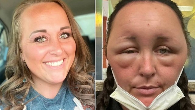 Americana foi chamada de “alien&iacute;gena” e Trakinas em raz&atilde;o da crise al&eacute;rgica – Foto: Reprodu&ccedil;&atilde;o