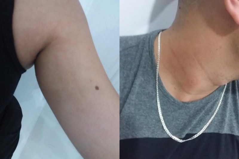 Les&otilde;es no bra&ccedil;o da mulher e no pesco&ccedil;o do homem – Foto: PM/Divulga&ccedil;&atilde;o/ND