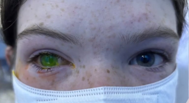 Infec&ccedil;&atilde;o que deixa os olhos verdes e causa dor equivalente &agrave; de parto aumenta na Austr&aacute;lia – Foto: R7/REPRODU&Ccedil;&Atilde;O/INSTAGRAM/@7NEWSSYD