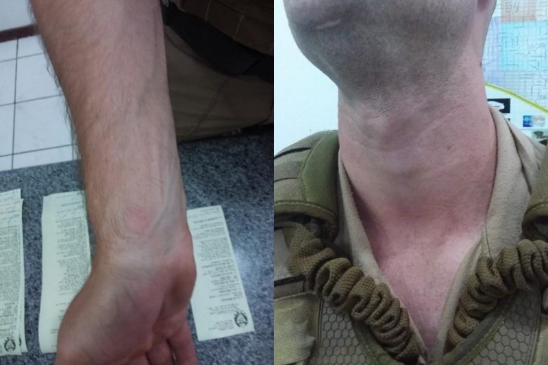 Imagem anexada ao Boletim de Ocorr&ecirc;ncia mostra as les&otilde;es que ficaram no policial – Foto: Pol&iacute;cia Militar/Divulga&ccedil;&atilde;o/ND