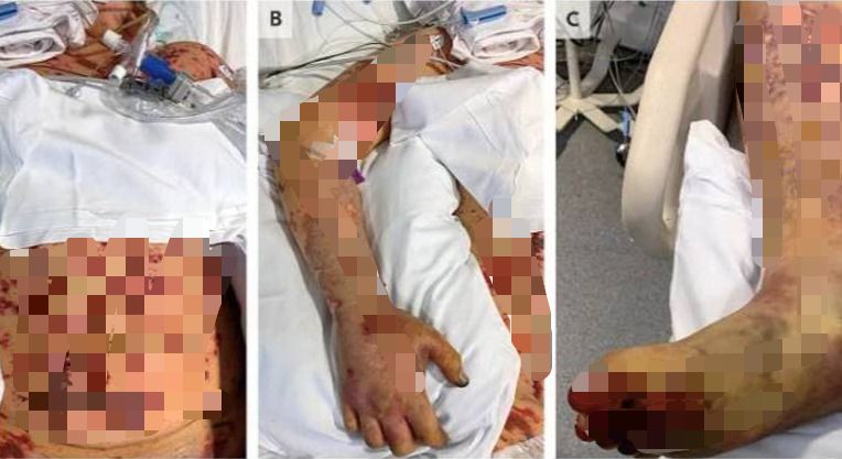 Jovem de 19 anos sofre s&eacute;ria infec&ccedil;&atilde;o e tem pernas e dedos amputados – Foto: NEW ENGLAND JOURNAL OF MEDICINE/Reprodu&ccedil;&atilde;o/ND