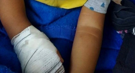 The child's hand was bandaged to protect access to medicines - Photo: Record TV / Reproduction / ND