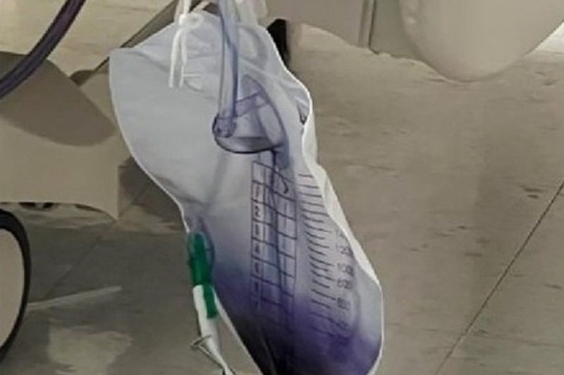 Urina roxa &eacute; causada por s&iacute;ndrome rara – Foto: REPRODU&Ccedil;&Atilde;O/R7/OXFORD MEDICAL CASE REPORTS/ND