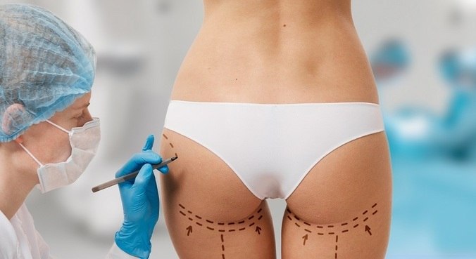 bumbum brasileiro cirurgia