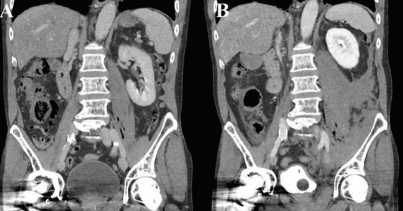 Exame de imagem mostra o ac&uacute;mulo de l&iacute;quidos e gases na &aacute;rea infectada – Foto: Science Direct/Reprodu&ccedil;&atilde;o/ND