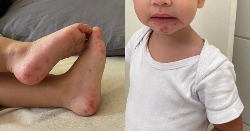 Pedro come&ccedil;ou a manifestar a doen&ccedil;a com uma febre – Foto: Arquivo Pessoal/Divulga&ccedil;&atilde;o/ND